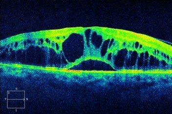 OCT tomographie par cohérence optique occlusions veineuses