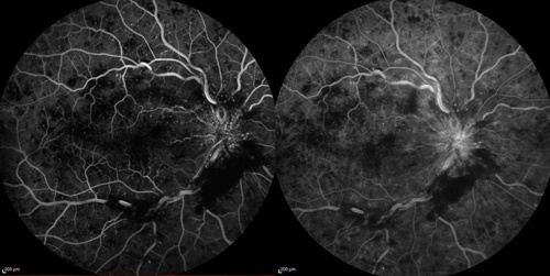 Angiographie Occlusions Veineuses