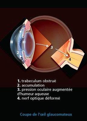 Glaucome